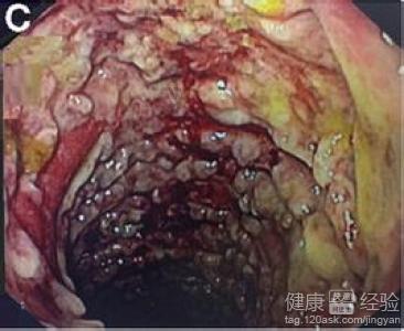 溃疡性结肠炎常用药