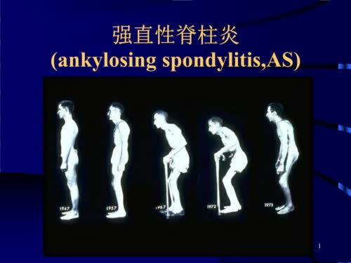 髋关节强直性脊柱炎区别