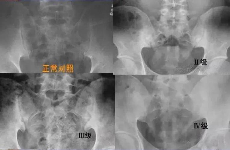 强直性脊柱炎骶髂关节退变治疗