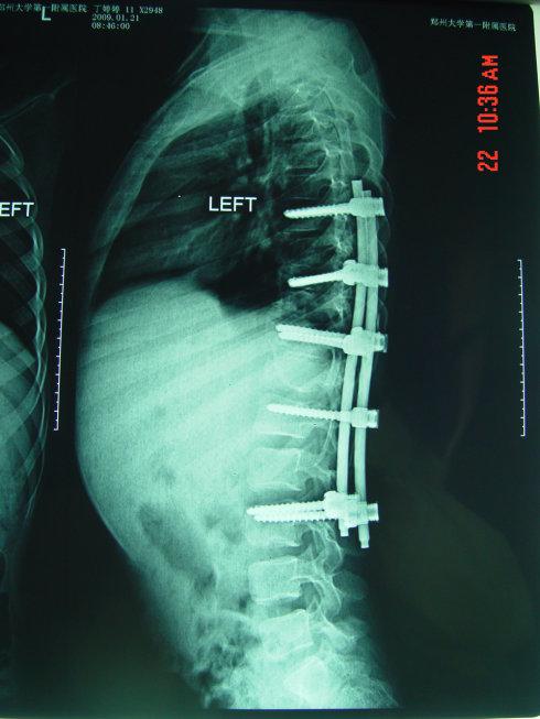 强直性脊柱炎rf阳性