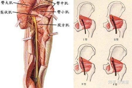 梨状肌综合征和强直性脊柱炎鉴别