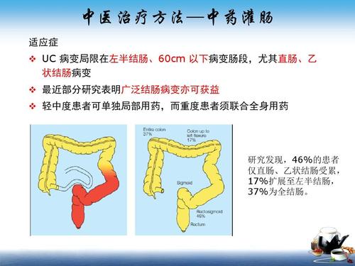 单核细胞移植治疗溃疡性结肠炎吗