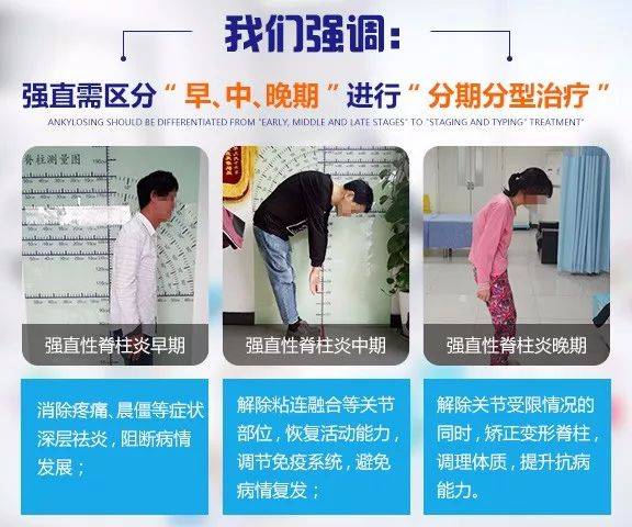 强直性脊柱炎发病怎么控制