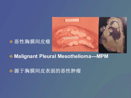 恶性间皮瘤