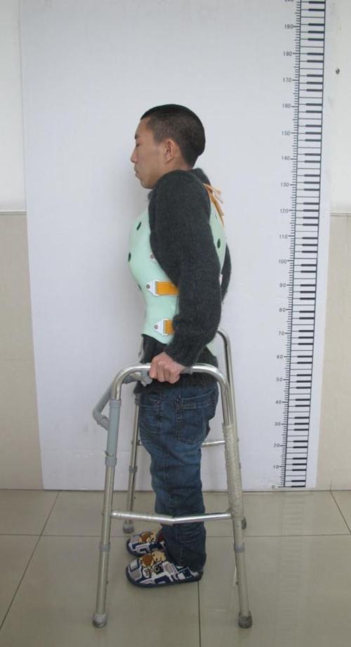 强直性脊柱炎不干预治疗