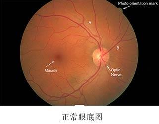 视网膜母细胞瘤