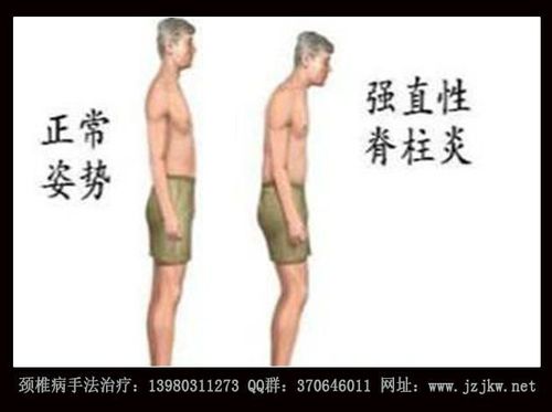 冻建症是强直性脊柱炎吗
