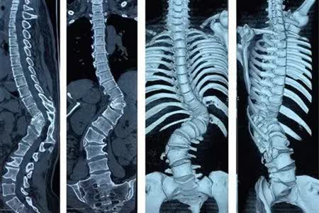 强直性脊柱炎发病最新研究
