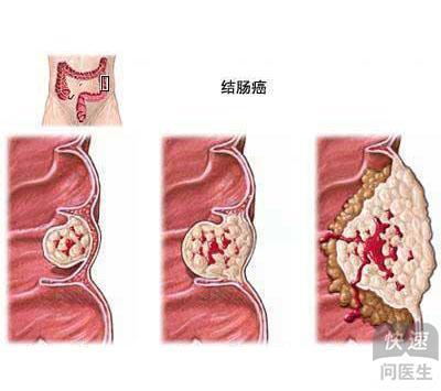 溃疡性结肠炎能吃西红柿吗
