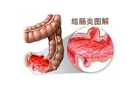 乌梅丸治溃疡性结肠炎有效果吗