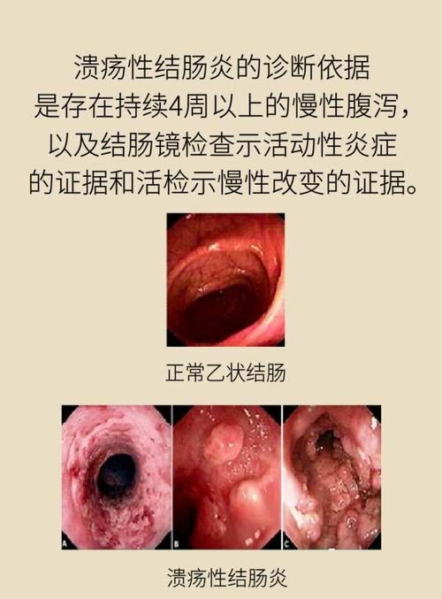 什么样的情况会得溃疡性结肠炎