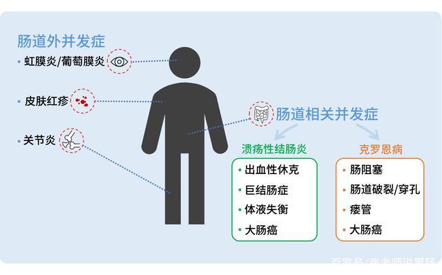 溃疡性结肠炎eb病毒阳性