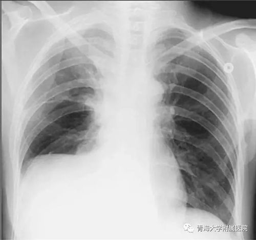恶性胸腔积液