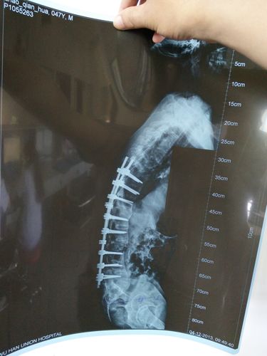 强直性脊柱炎理疗是什么