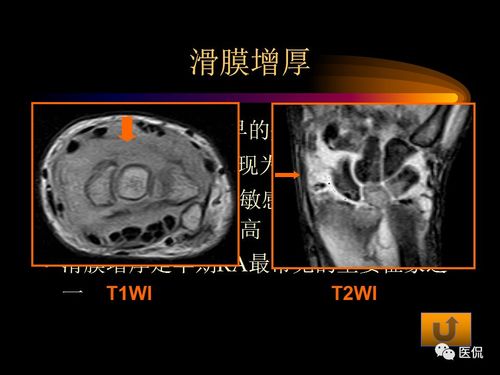 强直性脊柱炎检查排除类风湿