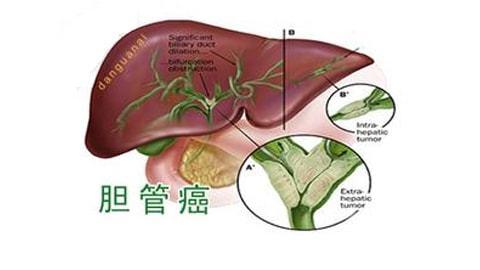 胆管癌