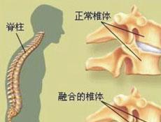 强直性脊柱炎治好需要多少钱