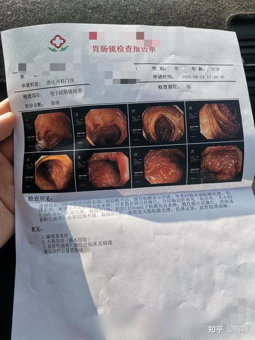 溃疡性结肠炎治愈后还会癌变吗