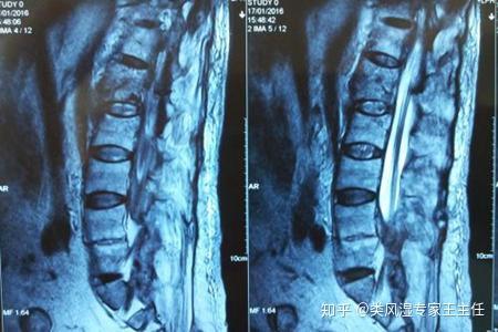 强直性脊柱炎其实不严重