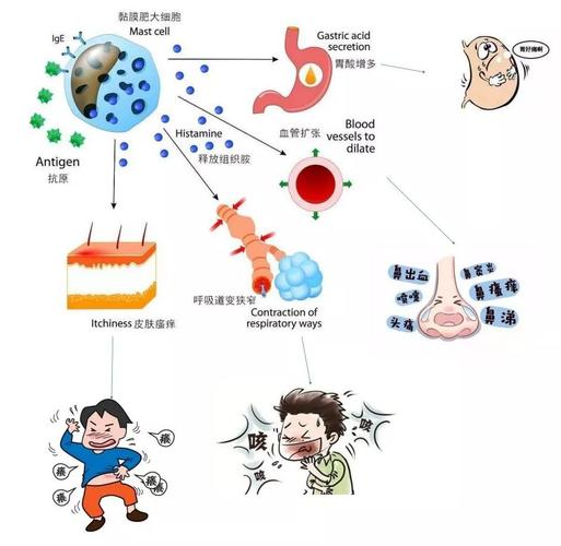 壳聚糖季铵盐与溃疡性结肠炎