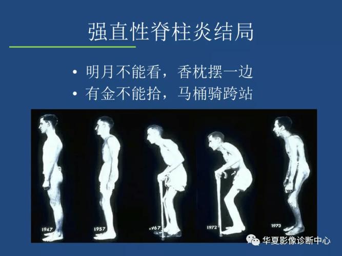 宿迁市强直性脊柱炎报销比例