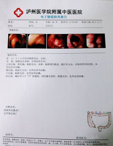 溃疡性乙状性结肠炎症状