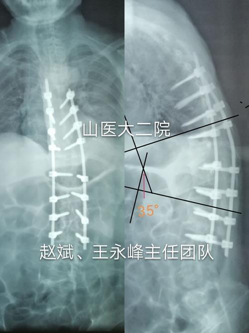 强直性脊柱炎能做矫正