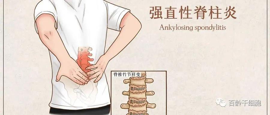 肠炎引起强直性脊柱炎怎么治