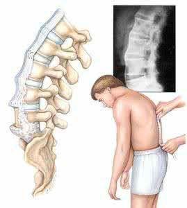 治强直性脊柱炎脊柱畸形哪家医院好