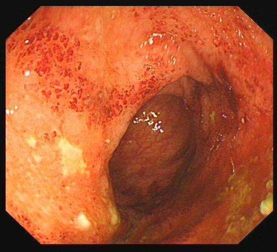 溃疡性结肠炎会放屁增多么