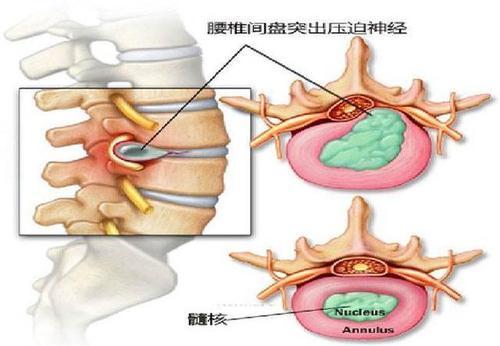 强直性脊柱炎埋线怎样治