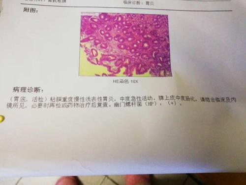溃疡性结肠炎用活检吗