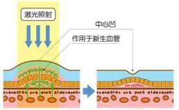 湿性黄斑变性