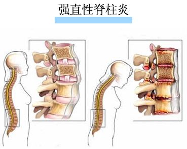男性强直性脊柱炎用药