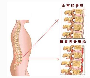 强直性脊柱炎吃三七粉好不好