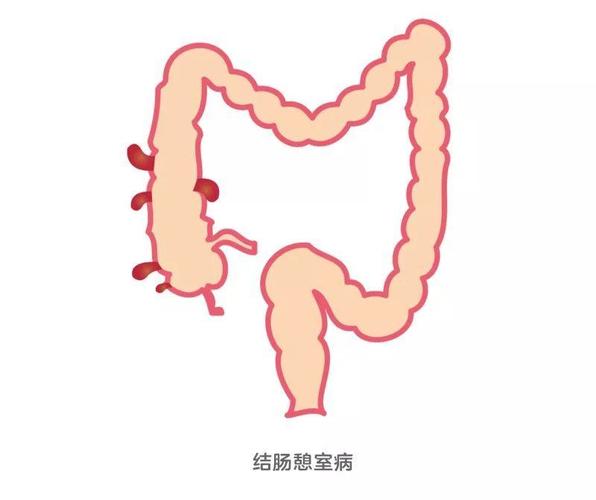 重度溃疡性结肠炎