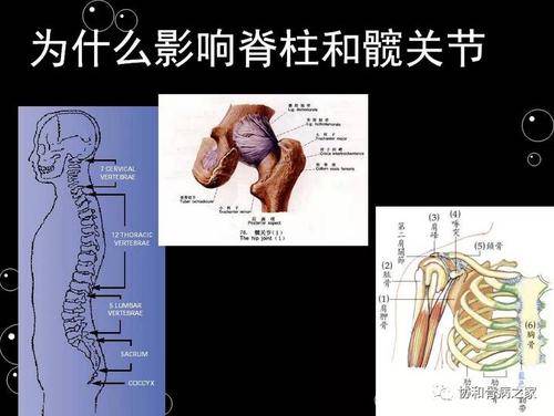 外伤诱发强直性脊柱炎算工伤吗