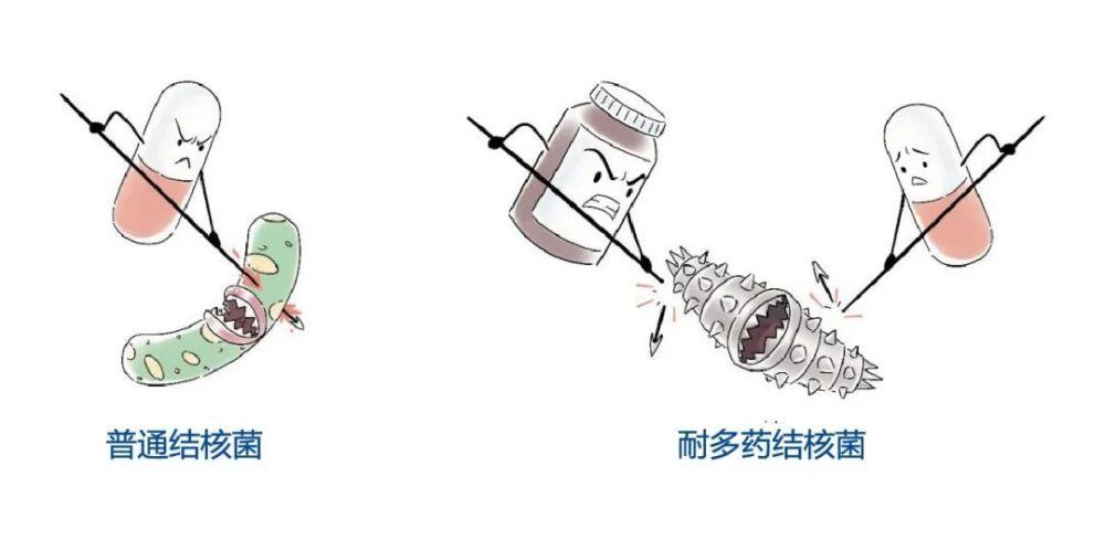 耐多药结核病