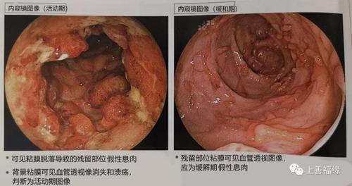 粉条溃疡性结肠炎能吃吗