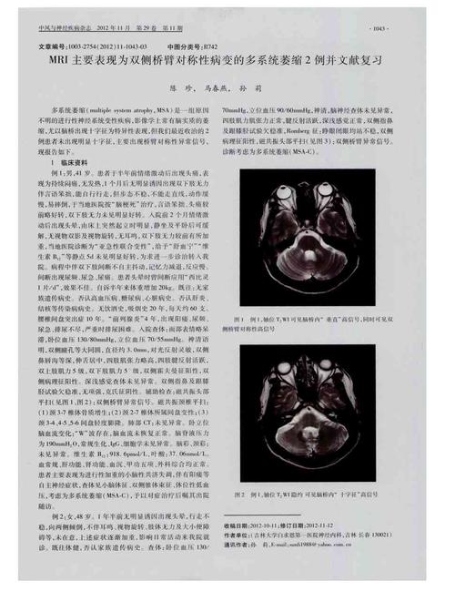 多系统萎缩