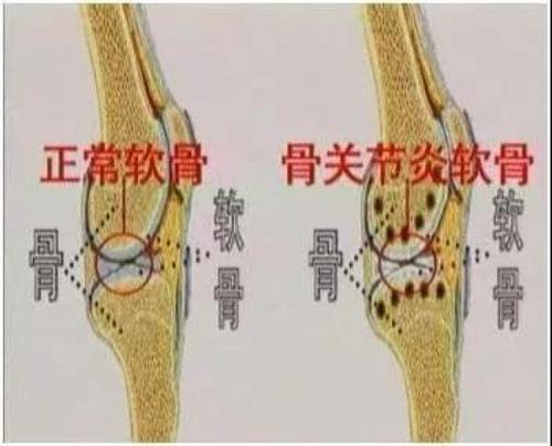 强直性脊柱炎如何损害髋关节
