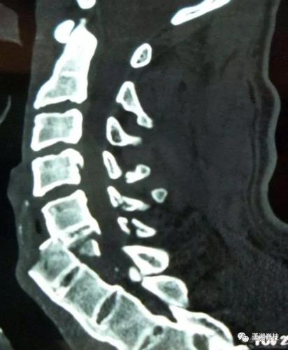 强直性脊柱炎腰椎突出怎么治疗