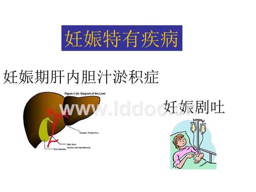 肝内胆汁淤积症