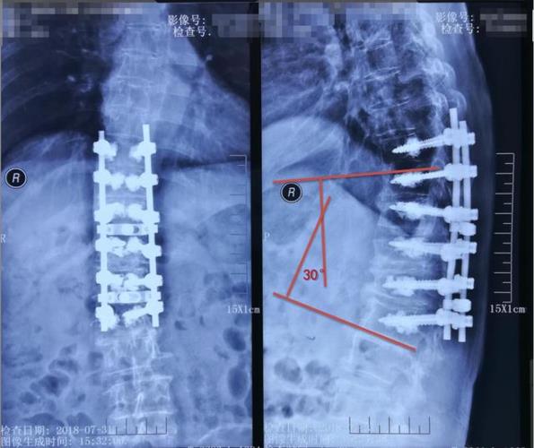 强直性脊柱炎胸腰椎侧后凸畸形