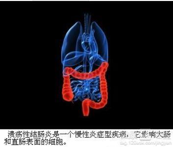 治疗严重溃疡性结肠炎需要多少钱