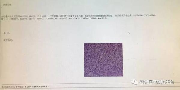 血管免疫母细胞性T细胞淋巴瘤