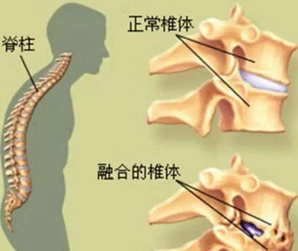 强直性脊柱炎算残疾