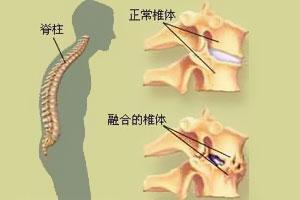 强直性脊柱炎的机制