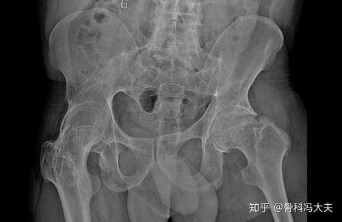 强直性脊柱炎全身骨疼痛