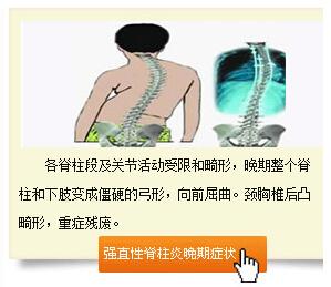 强直性脊柱炎臀部痛要做哪些运动